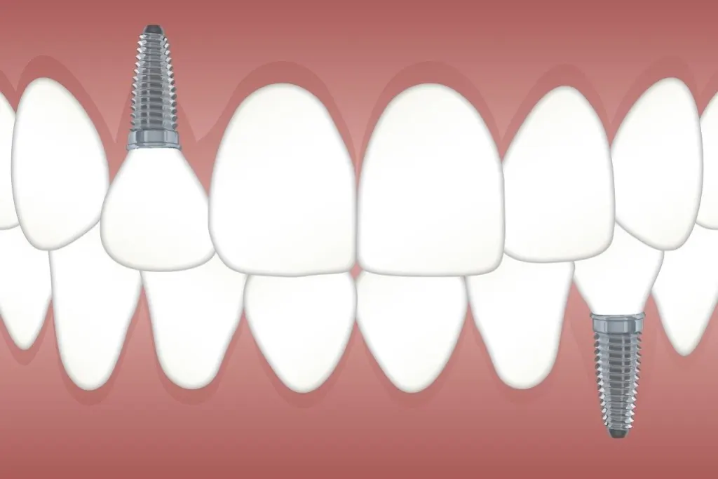 découvrez les implants oculaires, des dispositifs innovants pour restaurer la vision ou remplacer l’œil après une chirurgie. informez-vous sur les types d’implants, leurs avantages, et les dernières avancées technologiques dans le domaine de l’ophtalmologie.